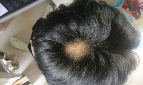 高中生女孩掉头发的原因及对策（掉发成为困扰，怎么解决？）